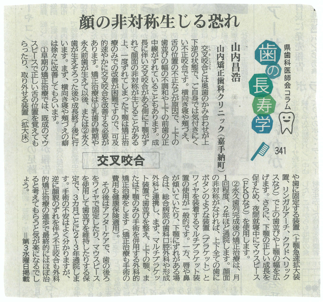【顔の非対称生じる恐れ】交叉咬合